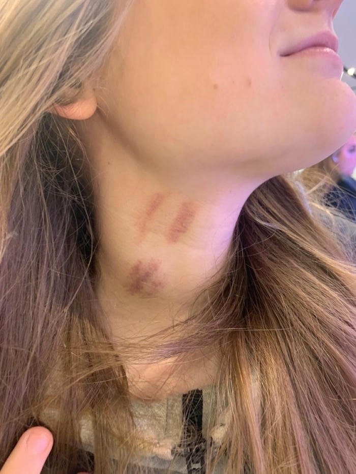 Blonde woman side neck red bruise mark close up