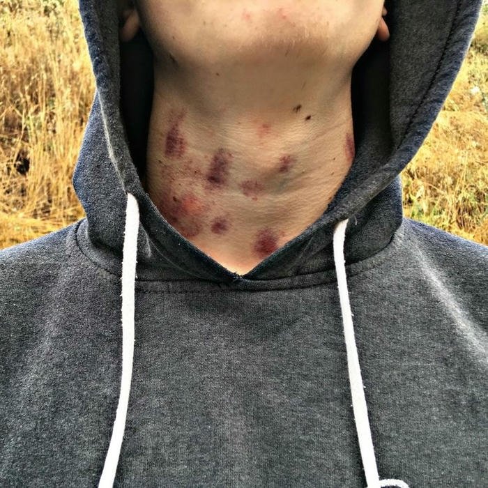 Grey hoodie man neck covered in red marks view