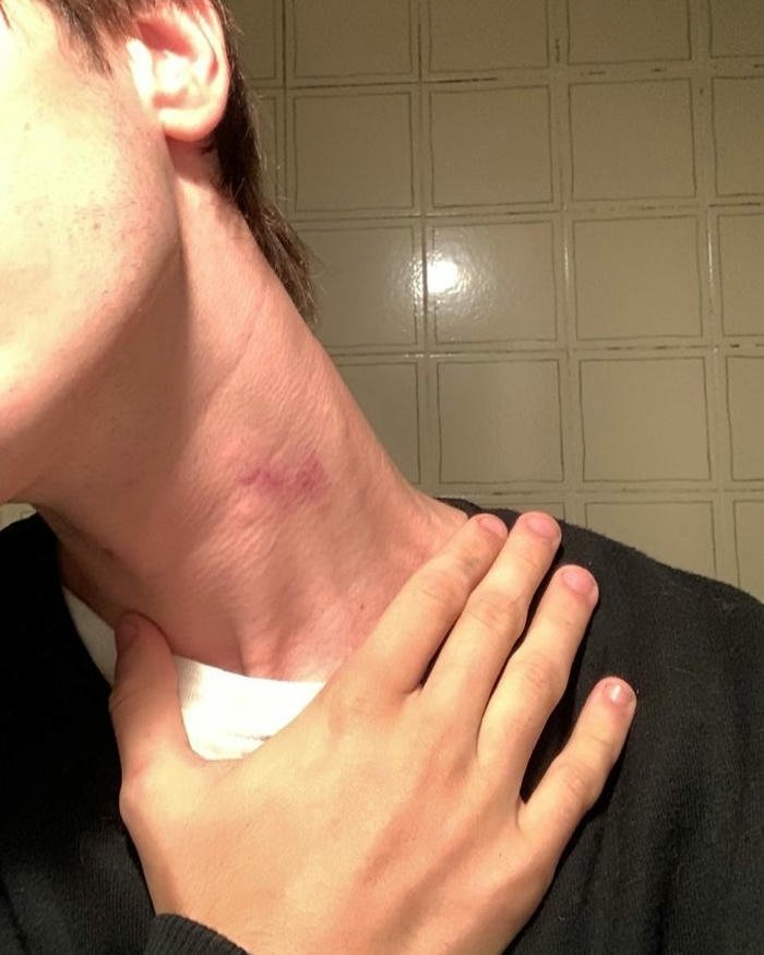 Hand pulling skin showing bright red neck mark view