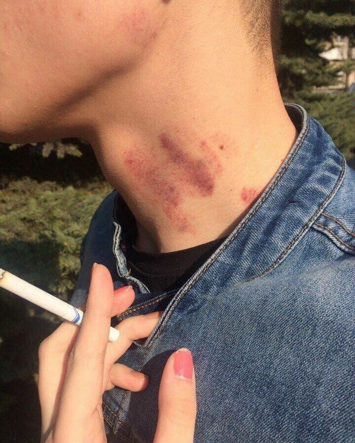 Hand touching neck visible bruise mark outdoor light view