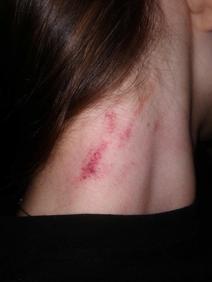 Love bites images back of neck red scratch marks hair