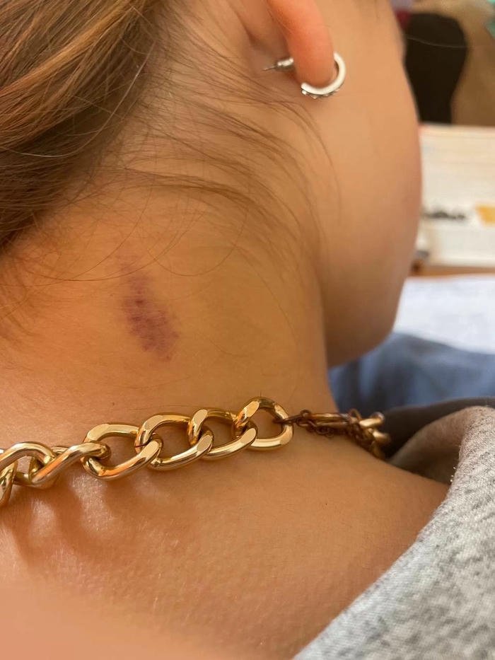 Love bites images gold chain back of neck bruise view