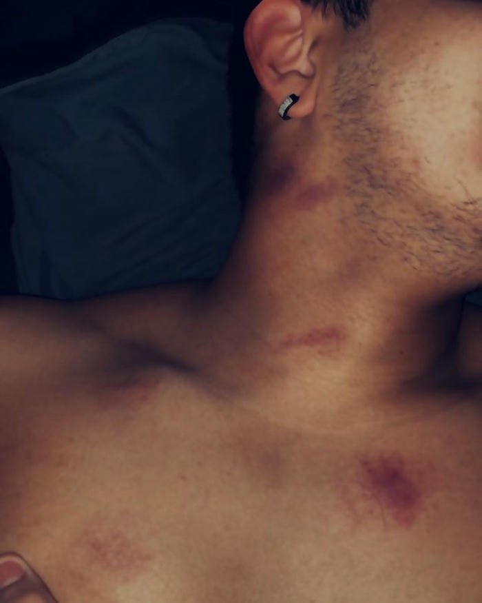 Love bites images male neck chest multiple dark red marks