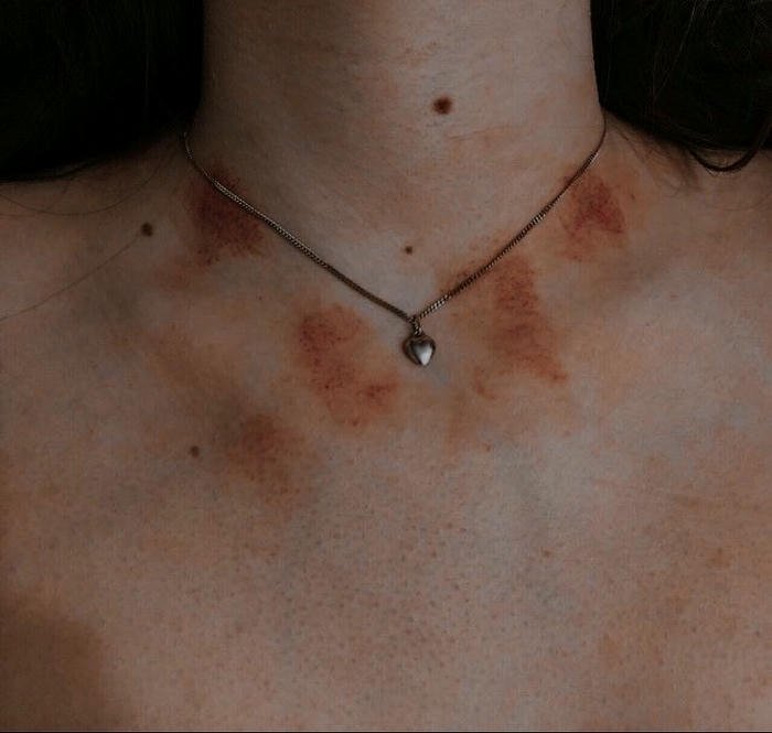 Love bites images multiple red spots chest neck skin view