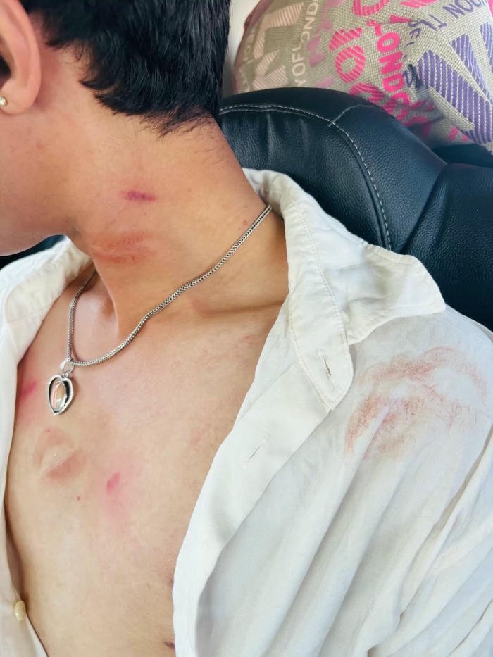 Love bites images open white shirt chest neck red marks