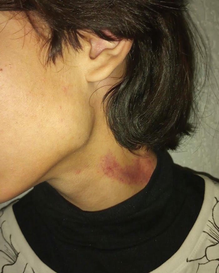 Love bites images short hair side profile distinct red mark