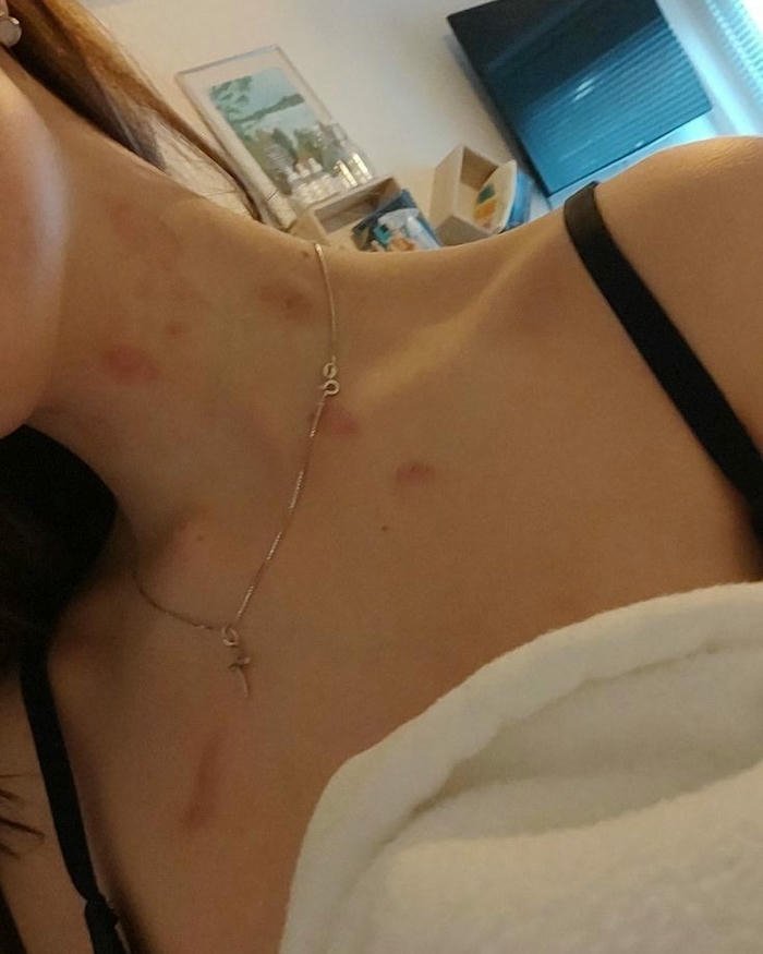 Love bites images woman shoulder strap neck red bruise marks