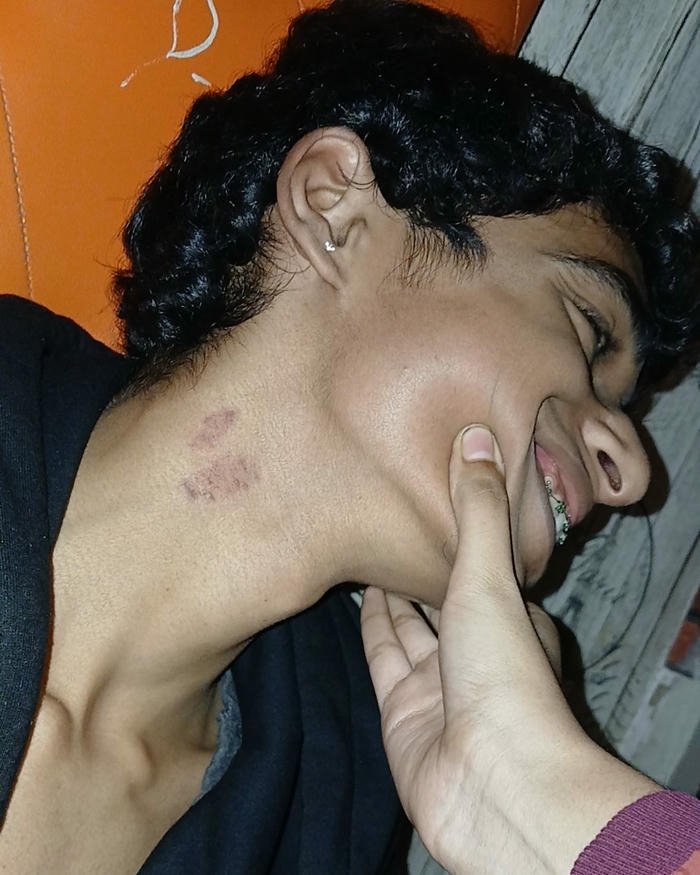 Man tilting head back showing neck bruise marks view