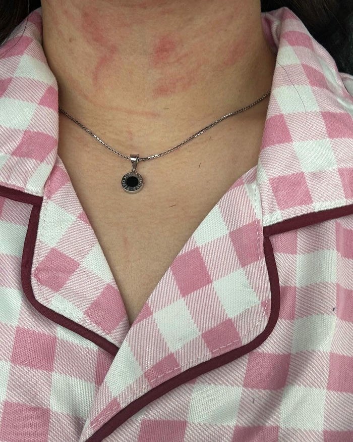 Pink plaid pajamas woman neck red marks skin view