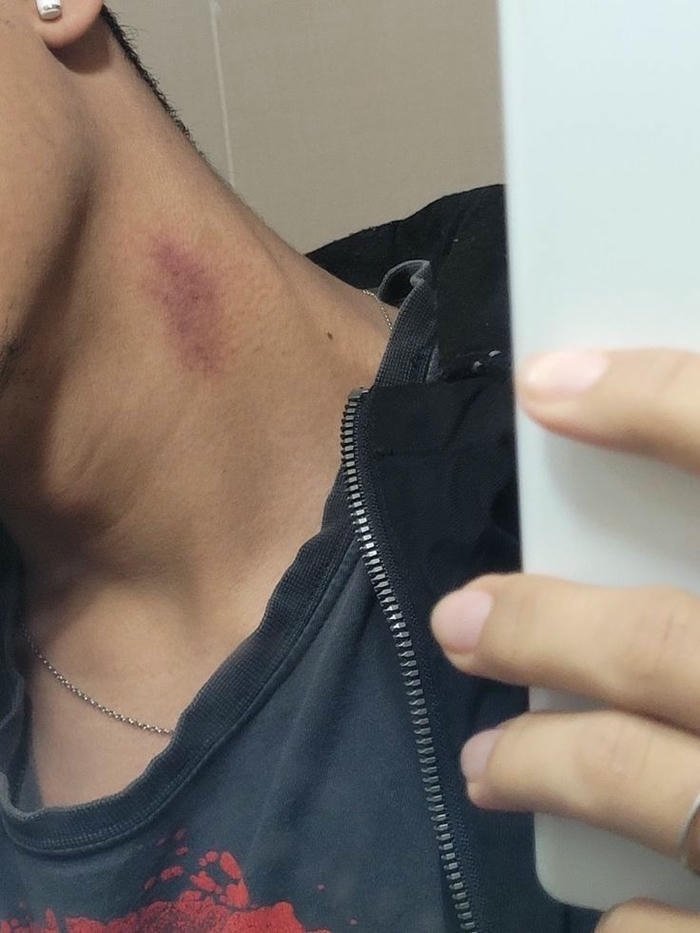 Real hickey mark neck male selfie dark shirt view