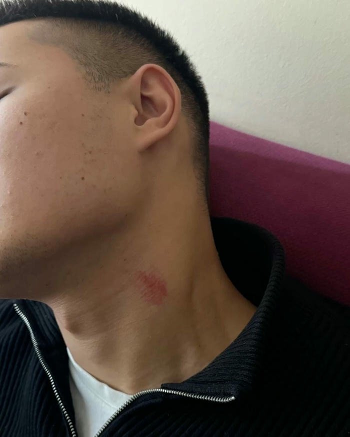 Side profile man short hair neck bruise mark view